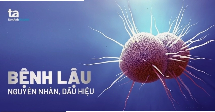 Hình ảnh minh họa triệu chứng bệnh lậu ở phụ nữ