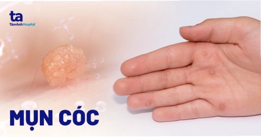 Hình ảnh minh họa virus HPV gây mụn cóc