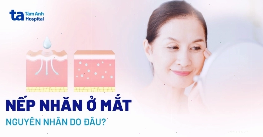Hình ảnh minh họa vùng da mắt xuất hiện nhiều nếp nhăn