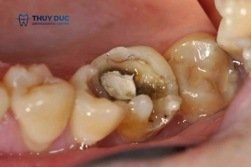 Hình ảnh răng sâu nặng dẫn đến mất răng