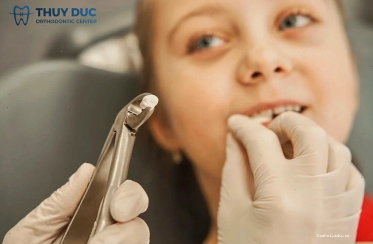Hình ảnh răng sữa bị sâu cần được điều trị