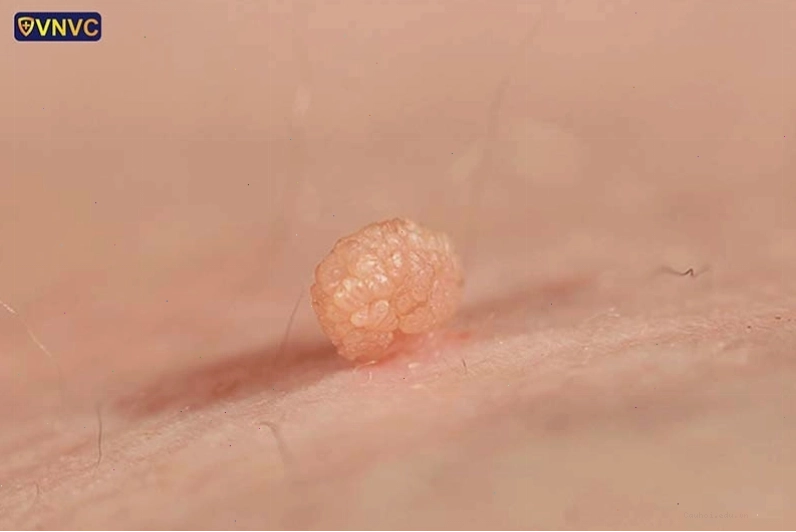 Hình ảnh sùi mào gà ở nam giới
