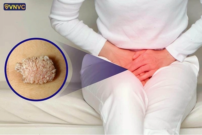 Hình ảnh sùi mào gà ở nữ giới