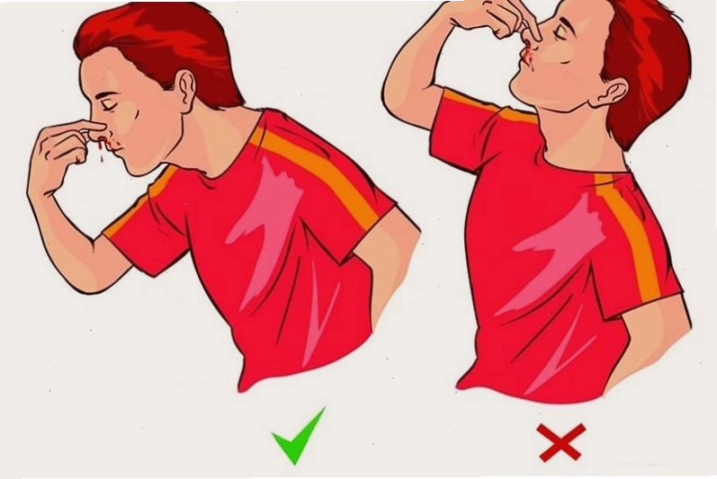 Hướng dẫn sơ cứu khi bị chảy máu mũi