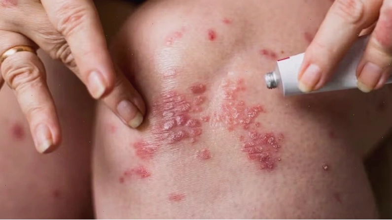 Lạm dụng corticoid làm suy yếu phản ứng miễn dịch tự nhiên của da