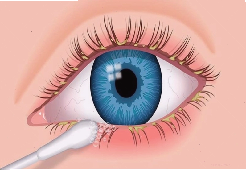 Mắt bị ngứa do viêm bờ mi