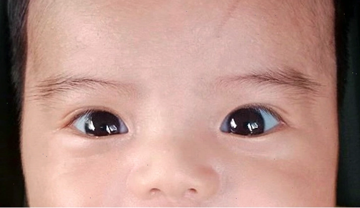 Mắt của em bé có lòng trắng màu xanh, cho thấy một tình trạng hiếm gặp