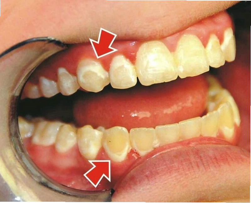 Men răng mỏng khiến màu răng ngả vàng tự nhiên
