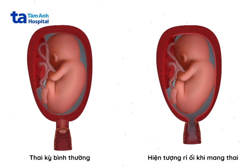 Minh họa hiện tượng rò rỉ ối trong thai kỳ