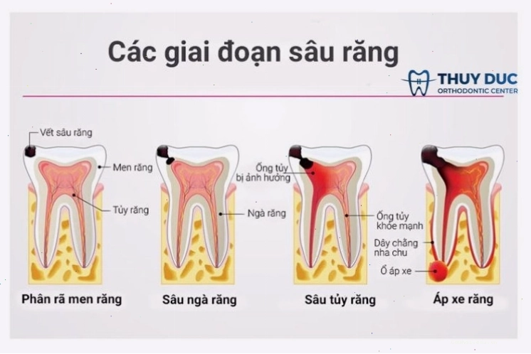 Minh họa quá trình sâu răng tấn công cấu trúc răng và lan đến tủy