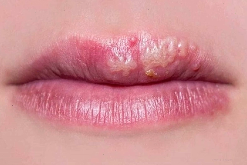 Môi bị nhiễm trùng nếu không được chăm sóc kỹ lưỡng sau phun