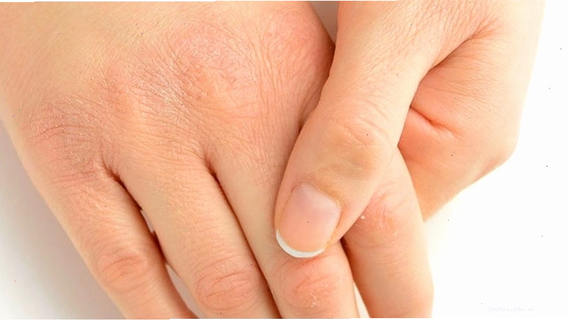 Mức độ teo da phụ thuộc vào độ mạnh của corticoid và thời gian sử dụng