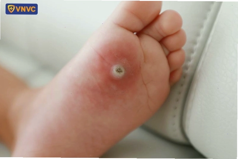 Mụn cóc lòng bàn chân