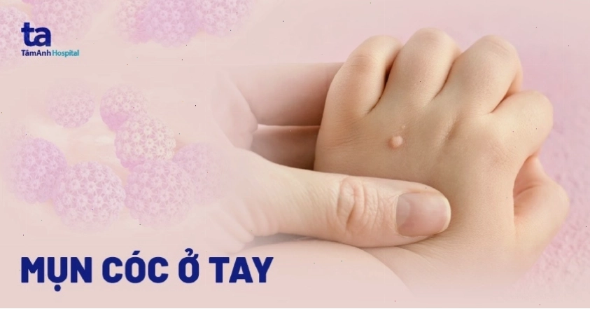 Mụn cóc xuất hiện ở ngón tay