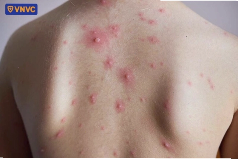 Mụn nước thủy đậu nổi trên lưng