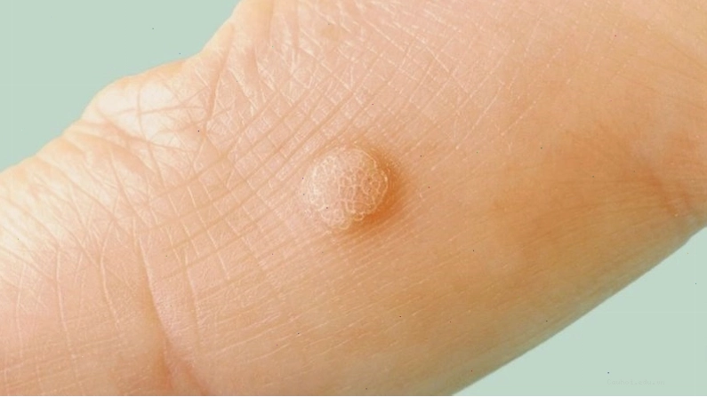 Mụn sùi mào gà có hình dạng như mào gà hoặc súp lơ