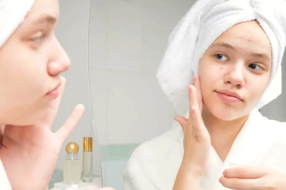 Mụn trứng cá xuất hiện trên da mặt