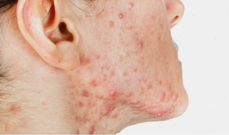 Mụn viêm là loại mụn trứng cá khó điều trị với nhiều cấp độ khác nhau