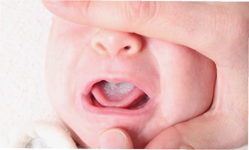 Nấm miệng gây lưỡi trắng và mùi hôi