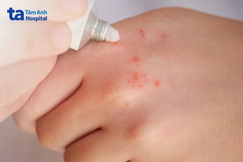 Người bệnh chỉ cần dùng một lớp mỏng kem bôi da theo chỉ định của bác sĩ