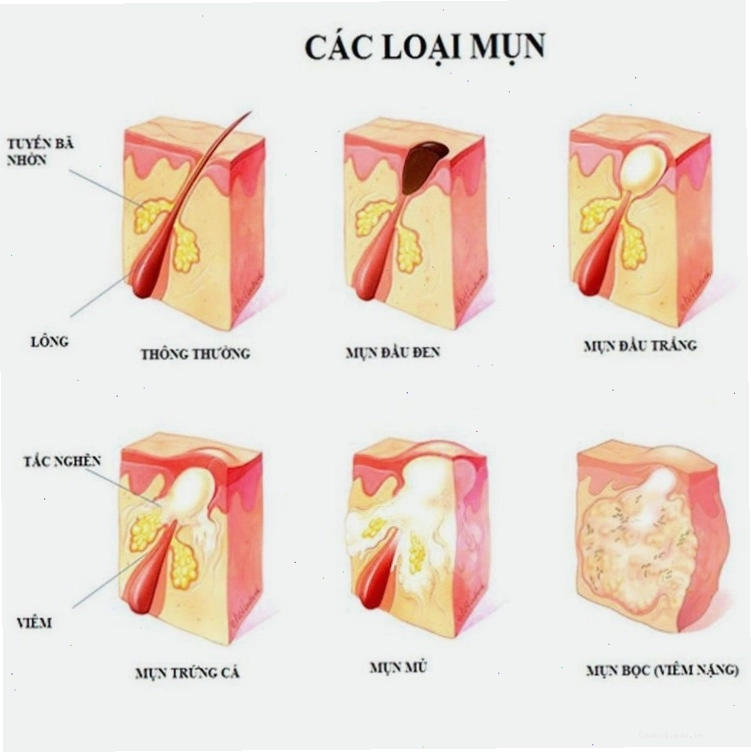 Nhiều loại mụn lưng khác nhau
