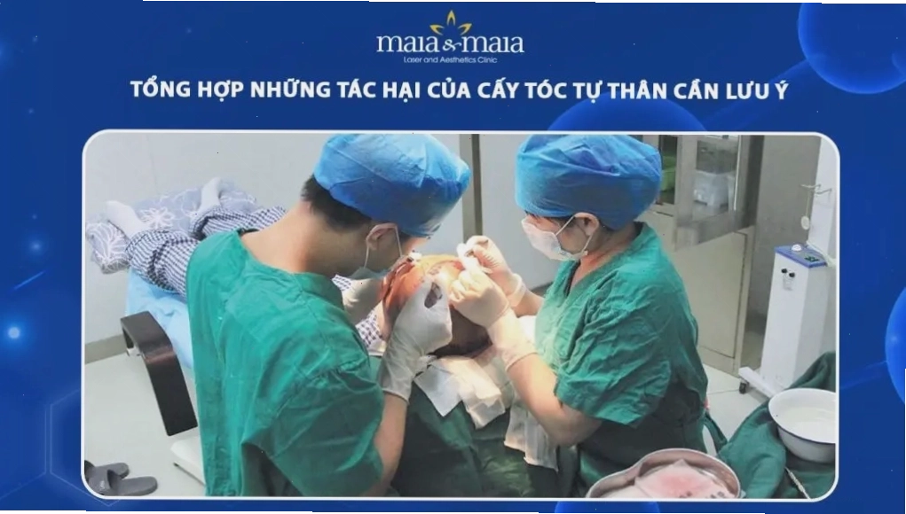 Những yếu tố cần cân nhắc trước khi thực hiện cấy tóc tự thân để tránh tác hại không mong muốn