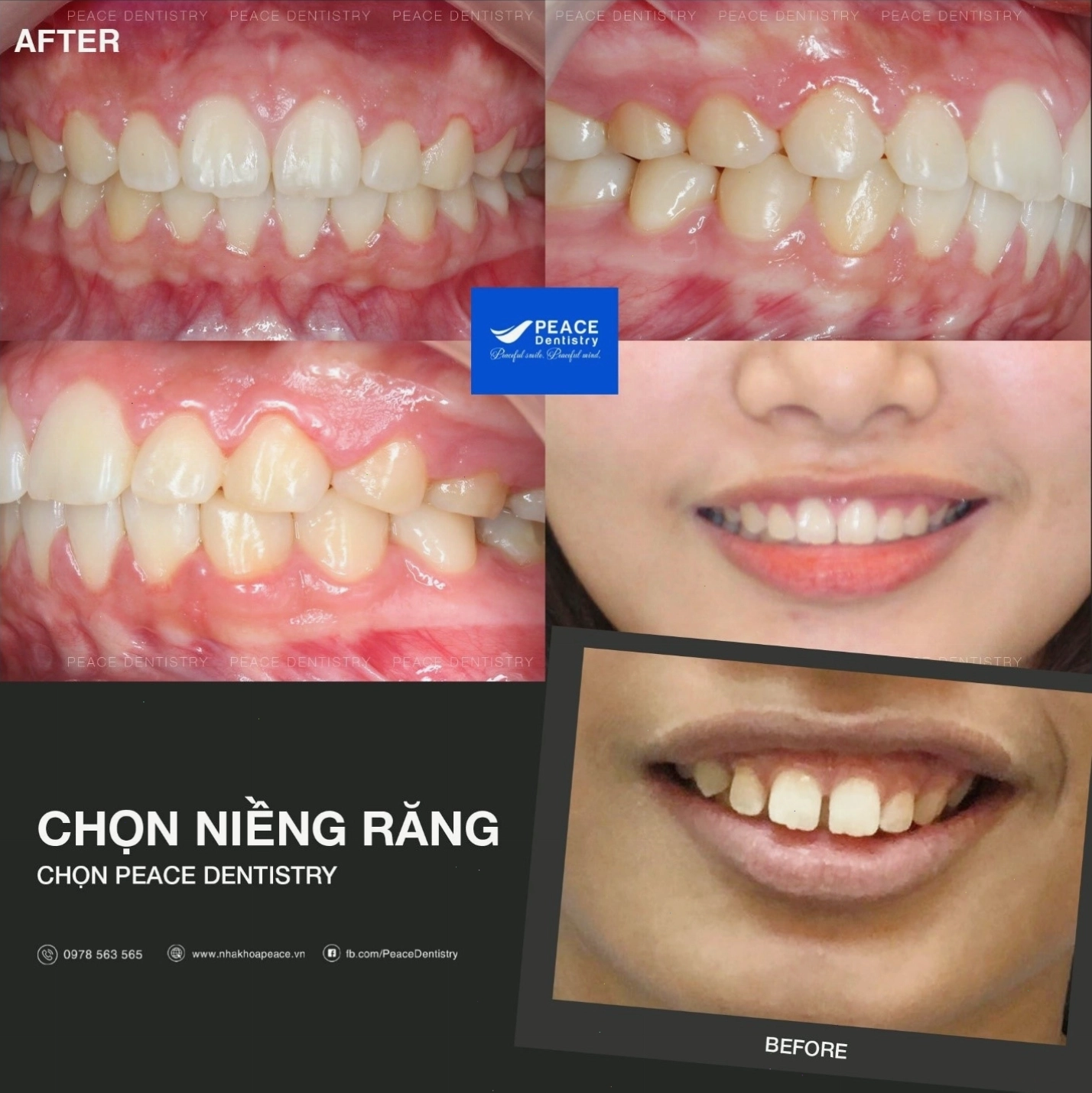 Niềng răng hô mang lại hiệu quả thẩm mỹ cao