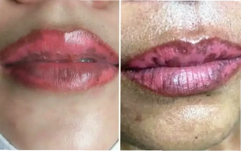Phun môi không đúng kỹ thuật có thể gây loang lổ môi hoặc nhiễm trùng