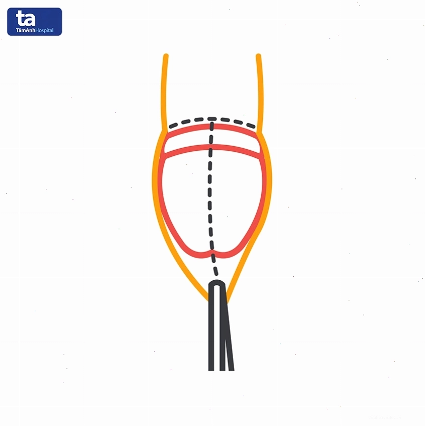 Phương pháp điều trị hẹp bao quy đầu