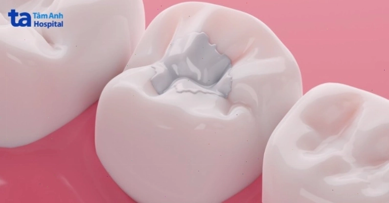 Quy trình điều trị bệnh sâu răng cho từng mức độ