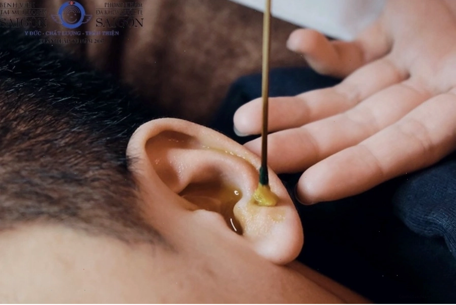 Ráy tai ướt màu vàng có mùi hôi là dấu hiệu cảnh báo viêm nhiễm tai