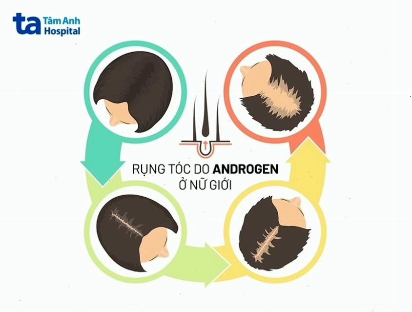 Rụng tóc nhiều ở nữ giới do rối loạn nội tiết tố