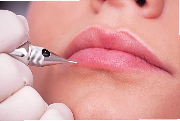 Sẹo môi sau khi thực hiện các thủ thuật thẩm mỹ không an toàn