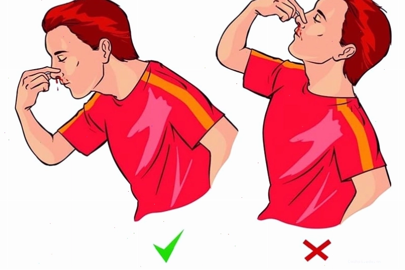 Sơ cứu đúng cách khi bị chảy máu cam