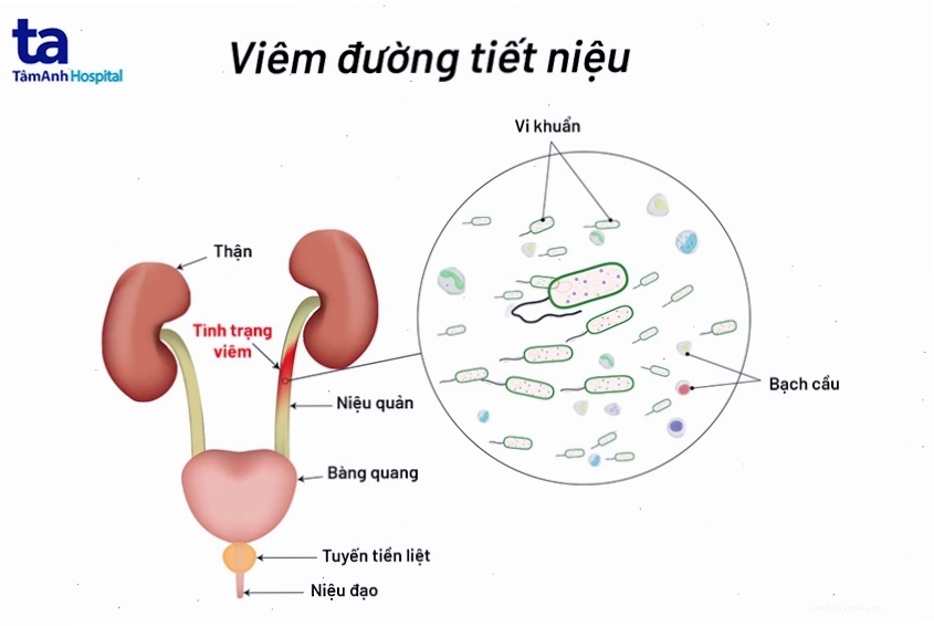 Sơ đồ minh họa đường tiết niệu và vị trí viêm nhiễm