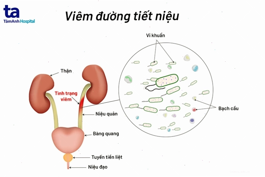 Sơ đồ minh họa hệ tiết niệu nữ và vị trí viêm nhiễm phổ biến