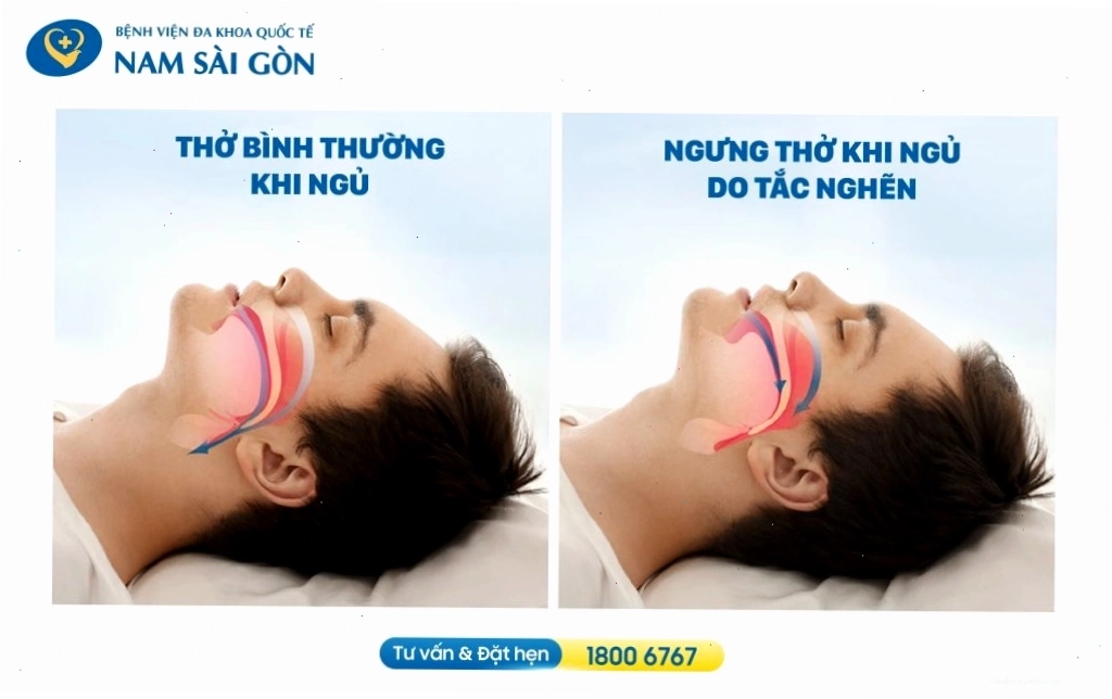 So sánh đường thở bình thường và đường thở bị tắc nghẽn gây ngáy ngủ