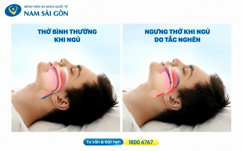 So sánh đường thở bình thường và đường thở bị tắc nghẽn khi ngủ ngáy