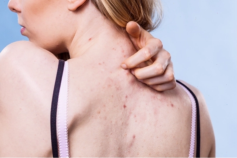 Sử dụng mỹ phẩm kém chất lượng gây tổn thương da lưng