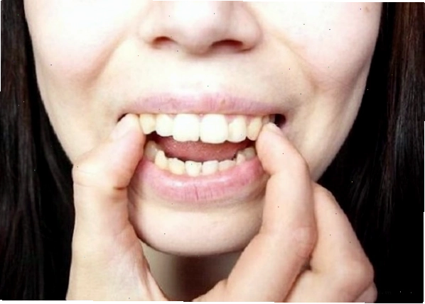 Sử dụng tay tác động lực nhẹ lên răng để làm răng bớt hô