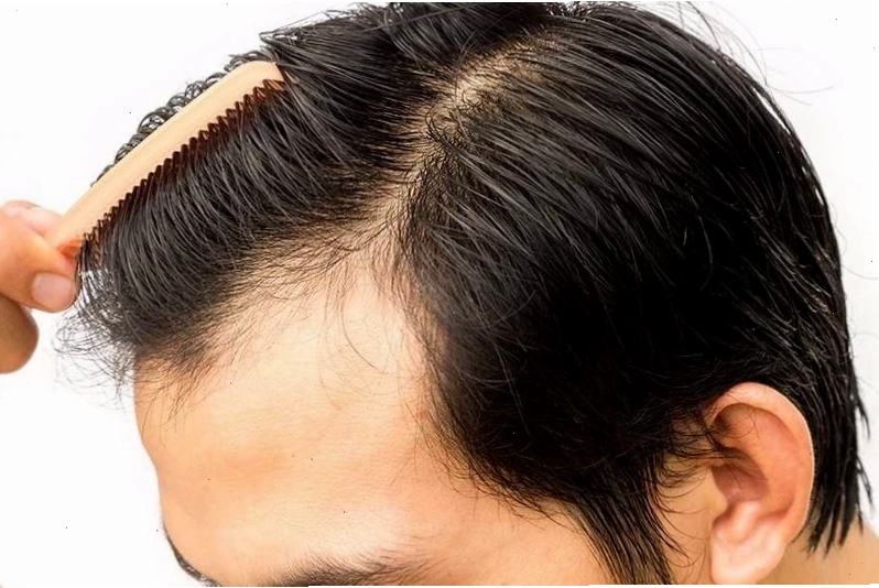 Tác hại của cấy tóc tự thân và cách xử lý khi gặp biến chứng