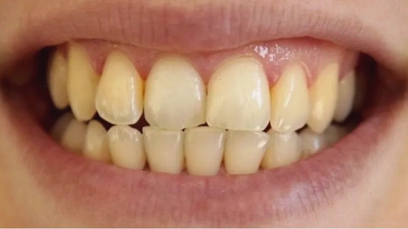 Tại sao đánh răng thường xuyên mà răng vẫn vàng