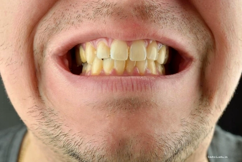 Tại sao đánh răng thường xuyên mà răng vẫn vàng: do di truyền, bệnh tật