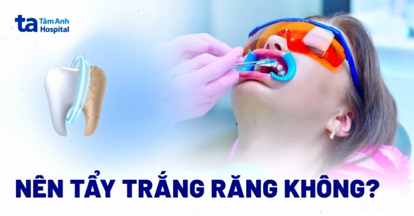 Tẩy trắng răng có nên làm không và những ai phù hợp