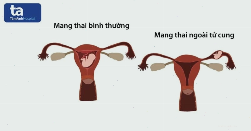 Thai ngoài tử cung là một nguyên nhân gây ra máu báo thai ra nhiều