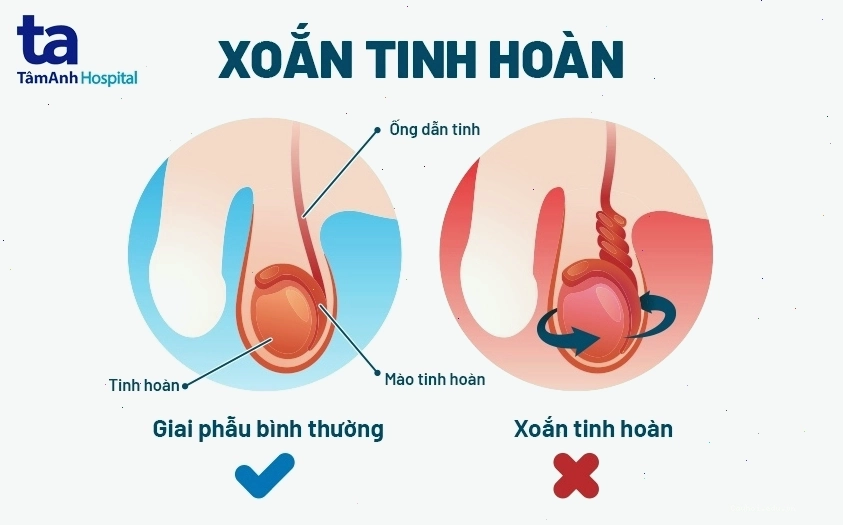 Thăm khám bác sĩ chuyên khoa khi có dấu hiệu xoắn tinh hoàn