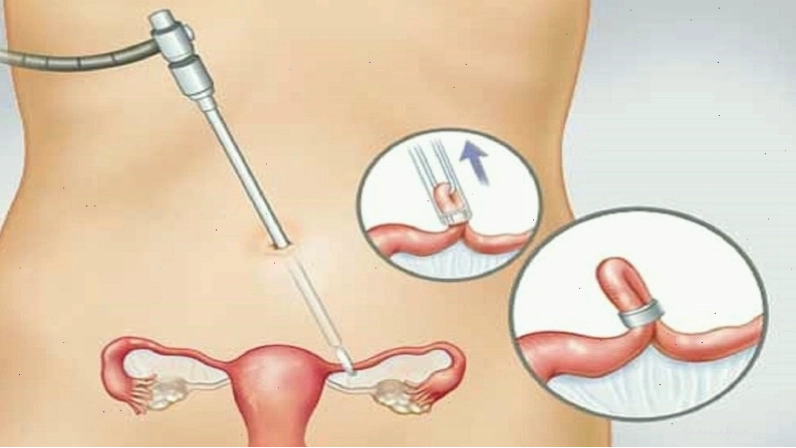 Thắt ống dẫn trứng là biện pháp tránh thai hiệu quả