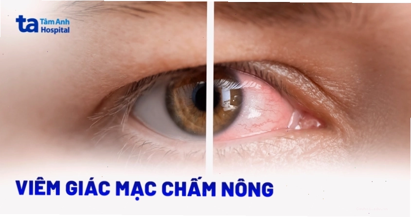 Thấu kính hiển vi soi rõ tình trạng viêm nhiễm trên mi mắt