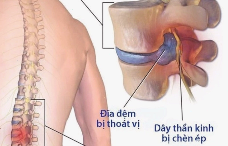 Thoát vị đĩa đệm gây chèn ép dây thần kinh dẫn đến tê chân