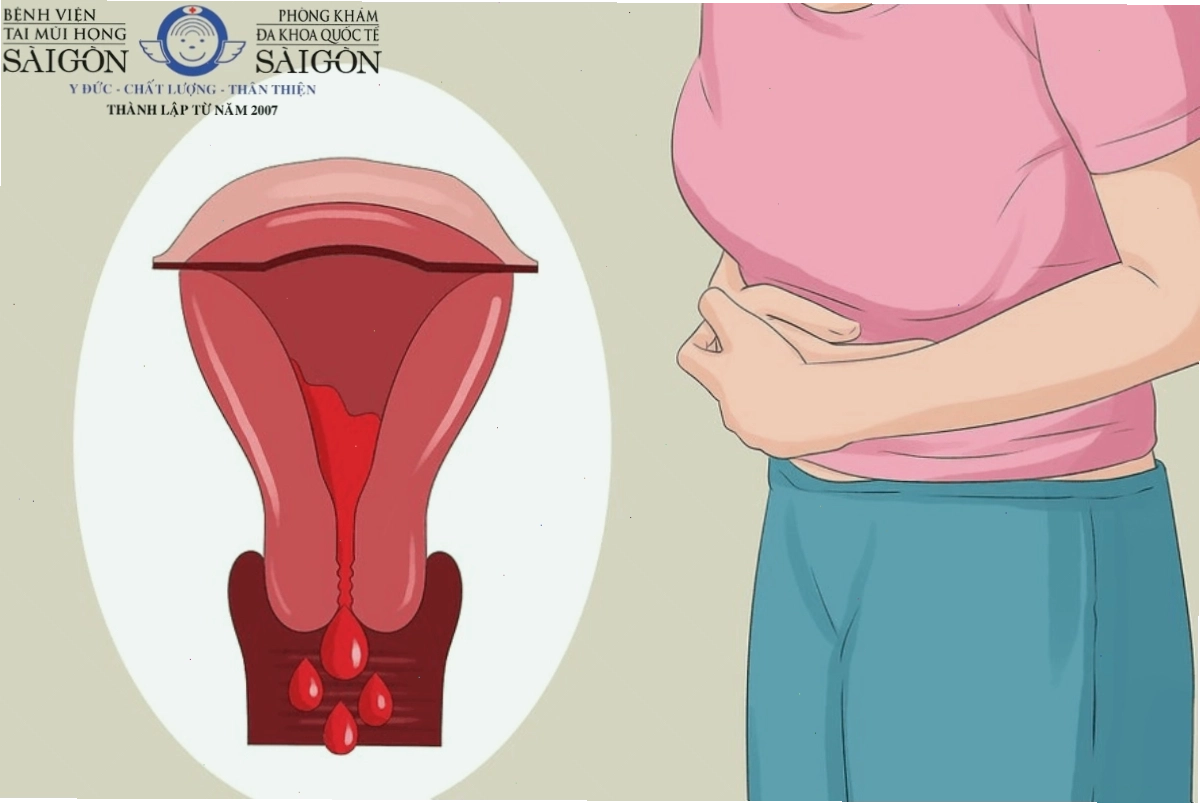 Thống kinh nguyên phát là tình trạng đau bụng kinh không liên quan đến bệnh lý